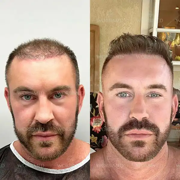 5000 grafts hair transplant before and after