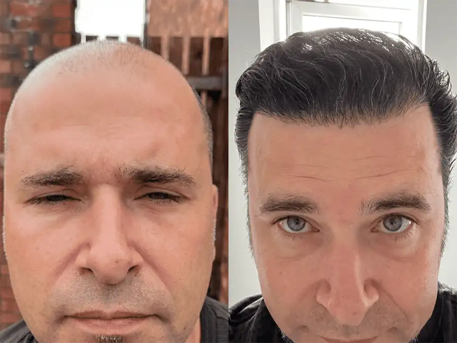 8000 grafts hair transplant before and after