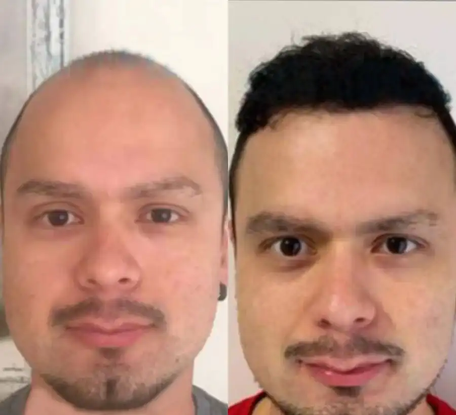 8000 grafts hair transplant