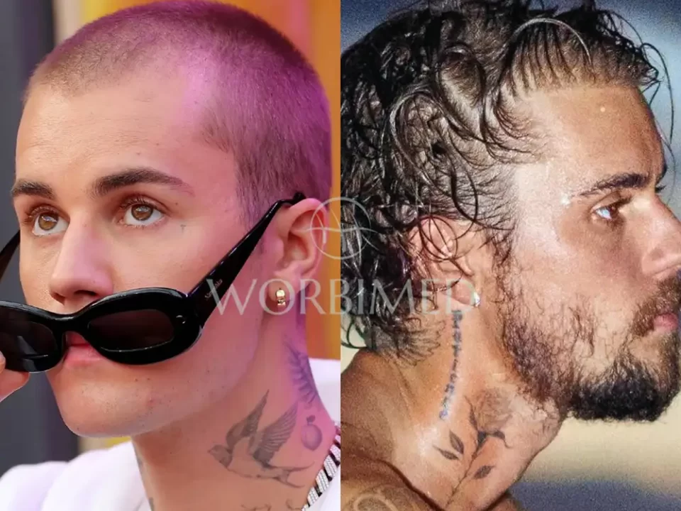 Justin Bieber hair transplant