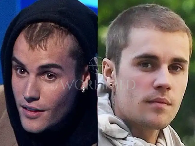 Justin Bieber Hair Transplant photo