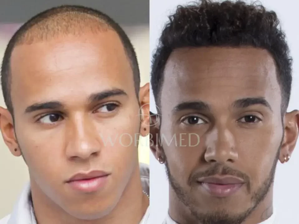 Lewis Hamilton hair transplant