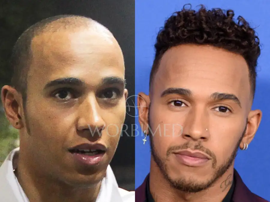 Lewis Hamilton hair transplant