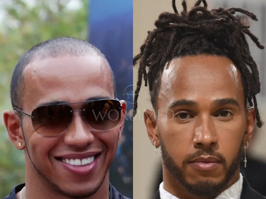 Lewis Hamilton hair transplant