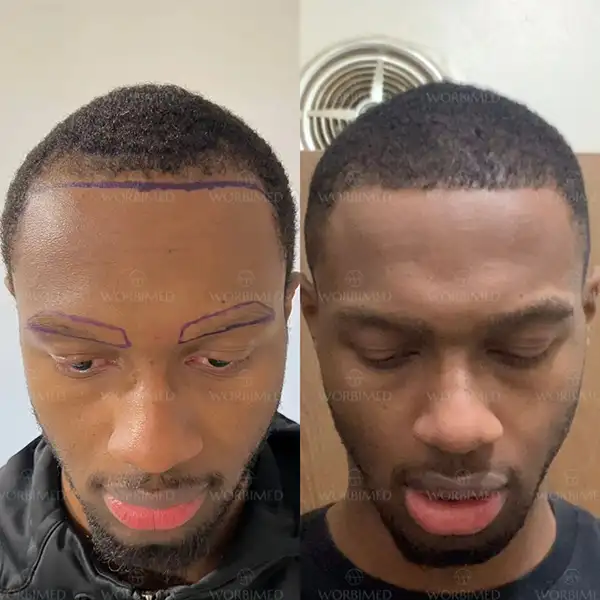 hair transplant befor and after turkey afro