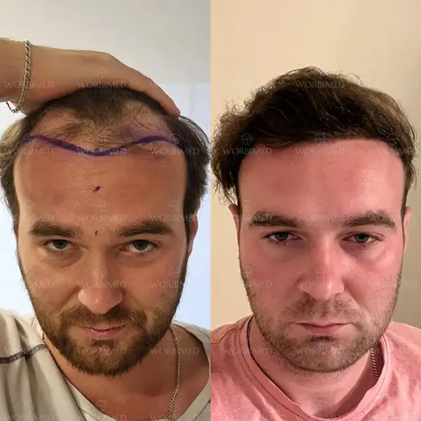 hair transplant befor and after turkey