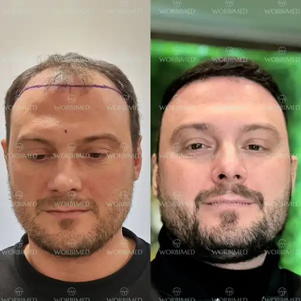 hair transplant before and after 