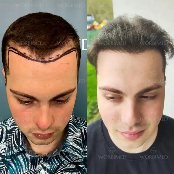 hair transplant before and after 2000 grafts result