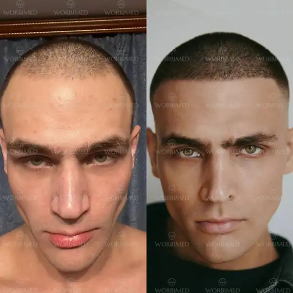 hair transplant before and after 2000 grafts