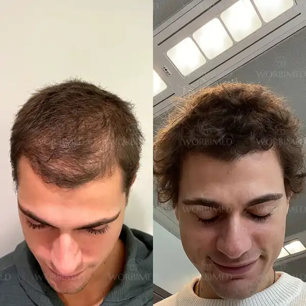 hair transplant before and after 4000 grafts result