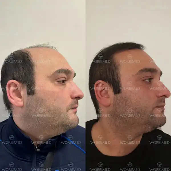 hair transplant before and after 4000 grafts results