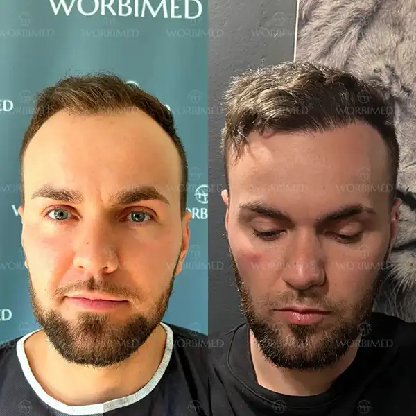 hair transplant before and after 4000 grafts