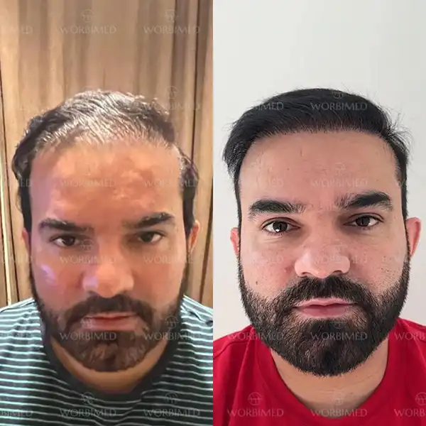 hair transplant before and after 4500 grafts results