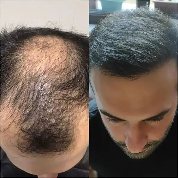 hair transplant before and after 5000 grafts results photo