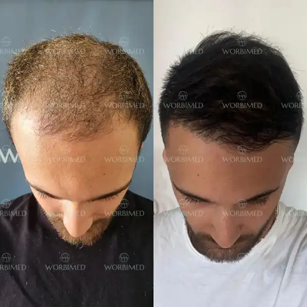 hair transplant before and after 5000 grafts resultss