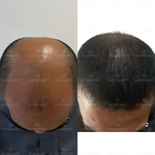 hair transplant before and after crown