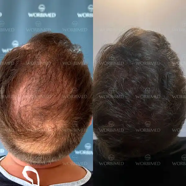 hair transplant before and after crown area