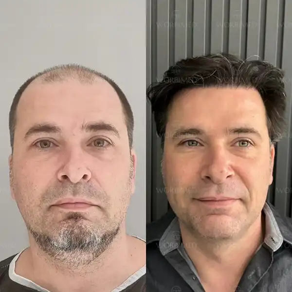 hair transplant before and after result