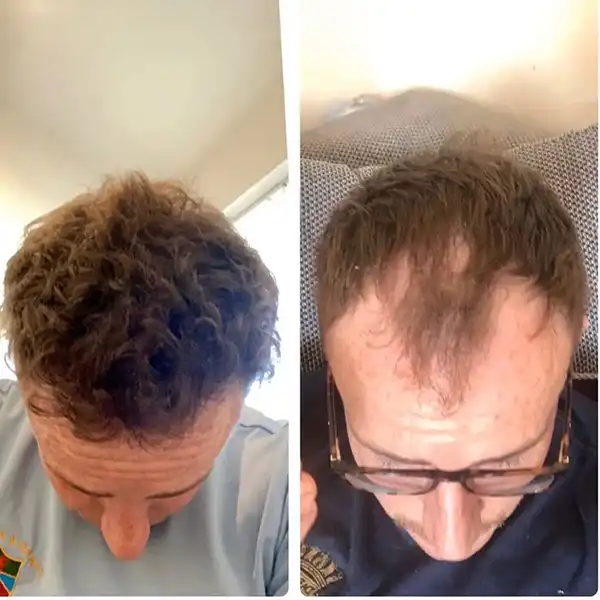 hair transplant before and after turkey 4000 grafts