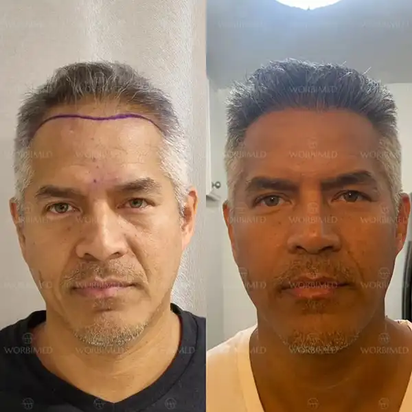 hair transplant before and after turkey result