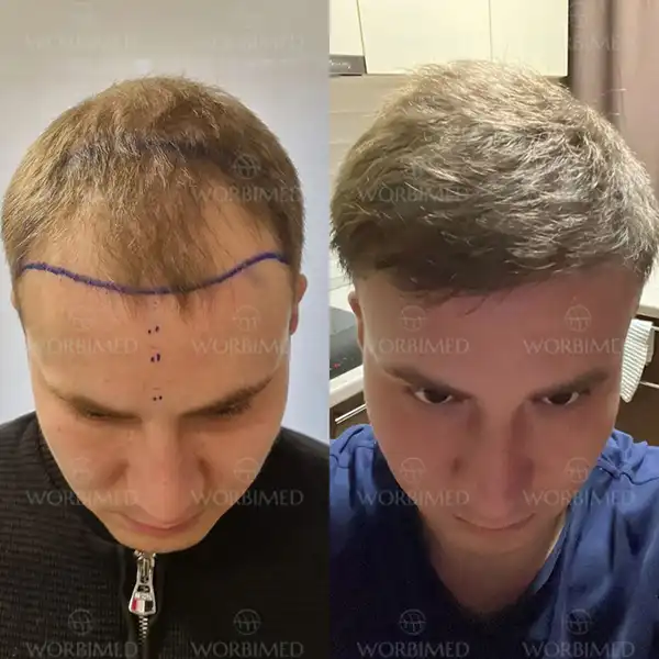 hair transplant before and after turkey results