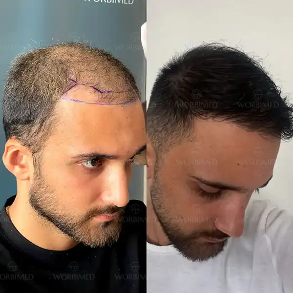 hair transplant before and after turkey