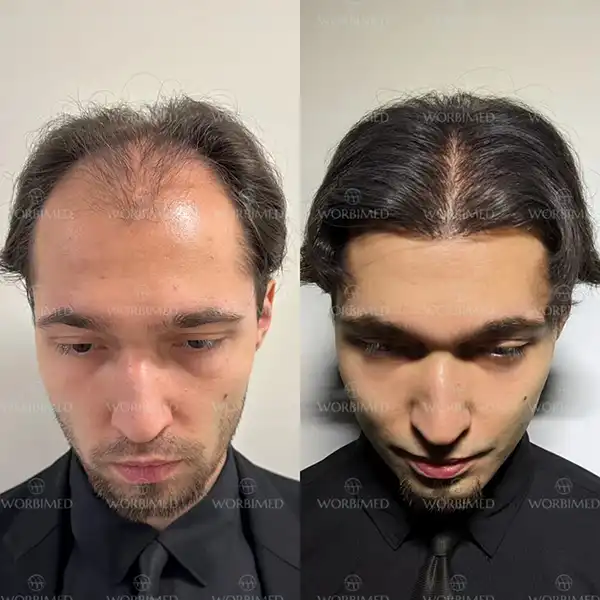 hair transplant before and after