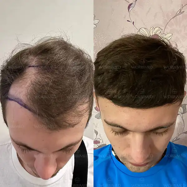 hair transplant turkey befor and after