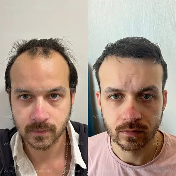 hair transplant before and after male