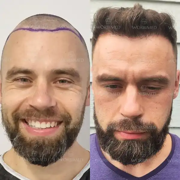 fue hair transplant before and after