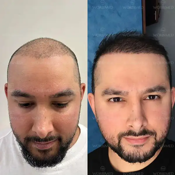 dhi hair transplant before and after
