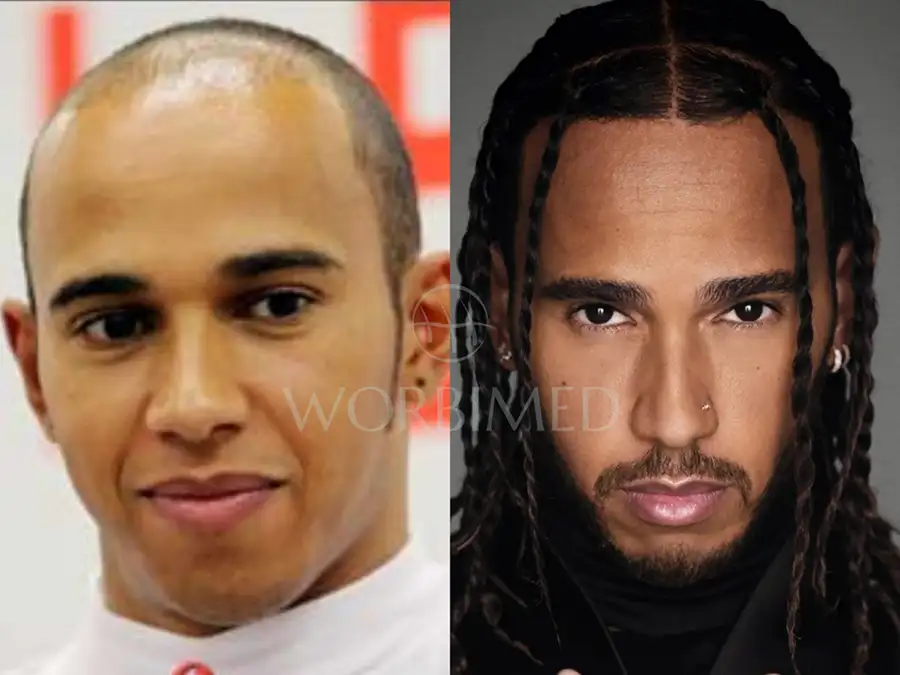 lewis-hamilton-hair-transplant before and after