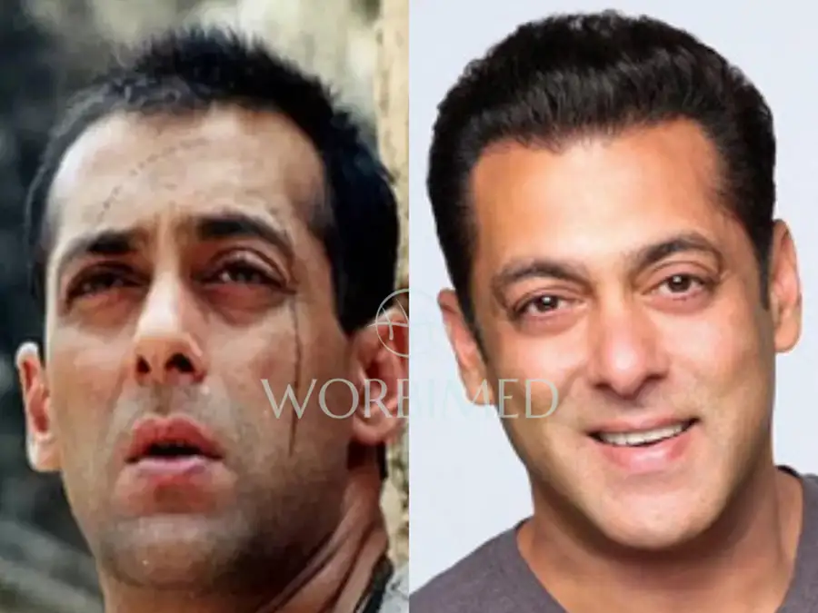 Salman Khan hair transplant before and after