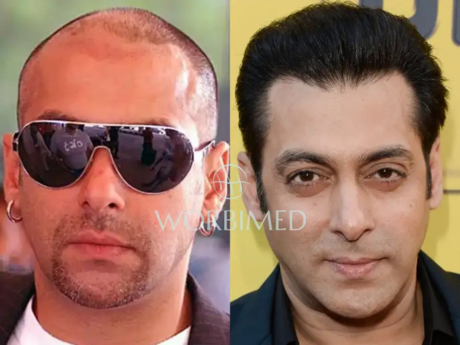 Salman Khan hair transplant