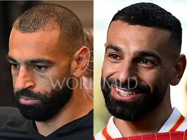 mo salah hair transplant