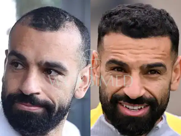 mo salah hair transplant before and after