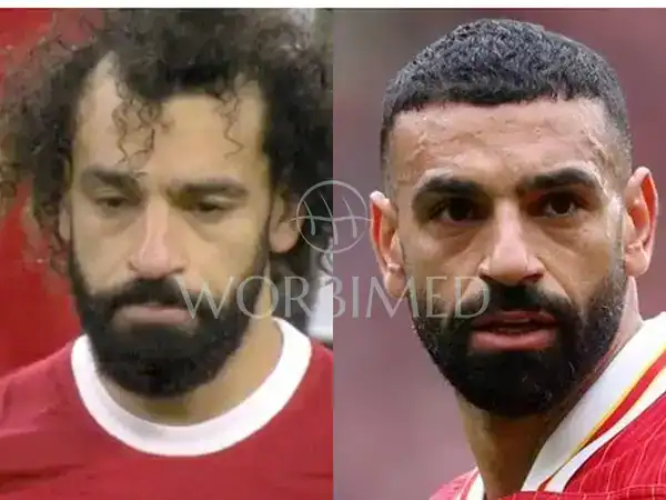 mo salah hair transplant before and after