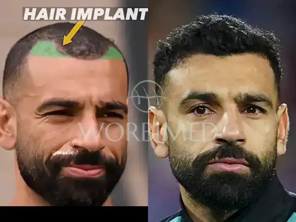 salah hair transplant