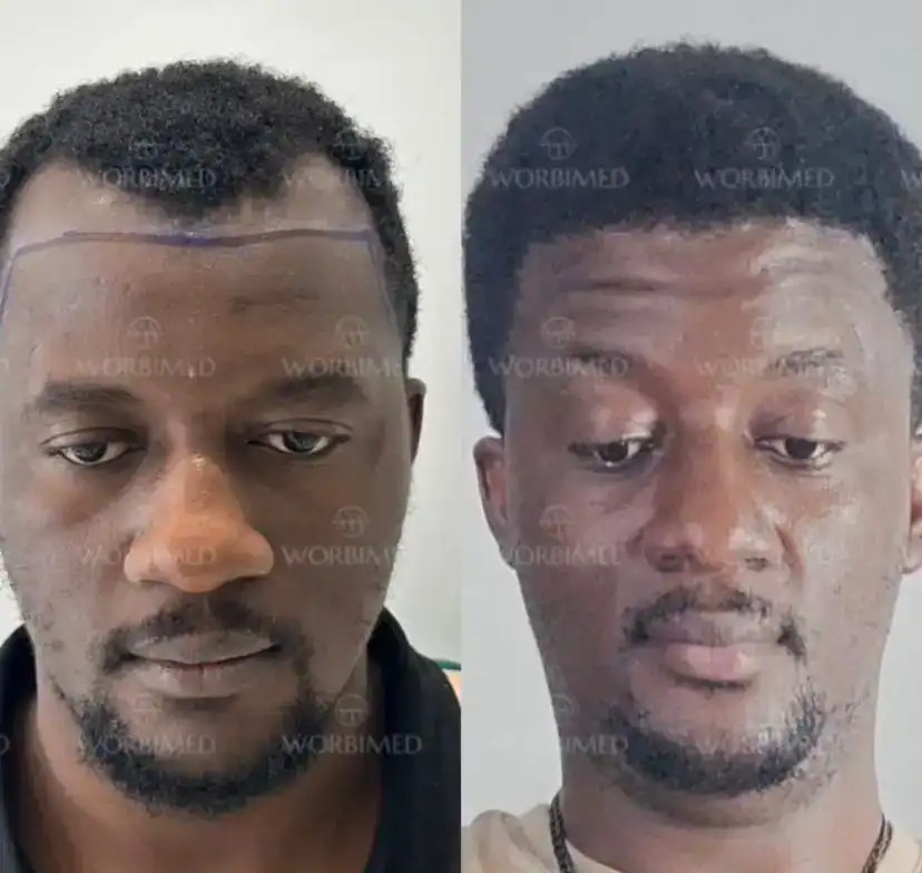 afro hair transplant