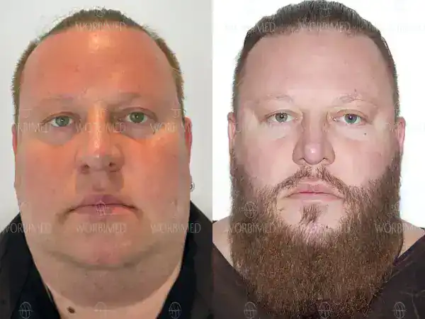 beard transplant