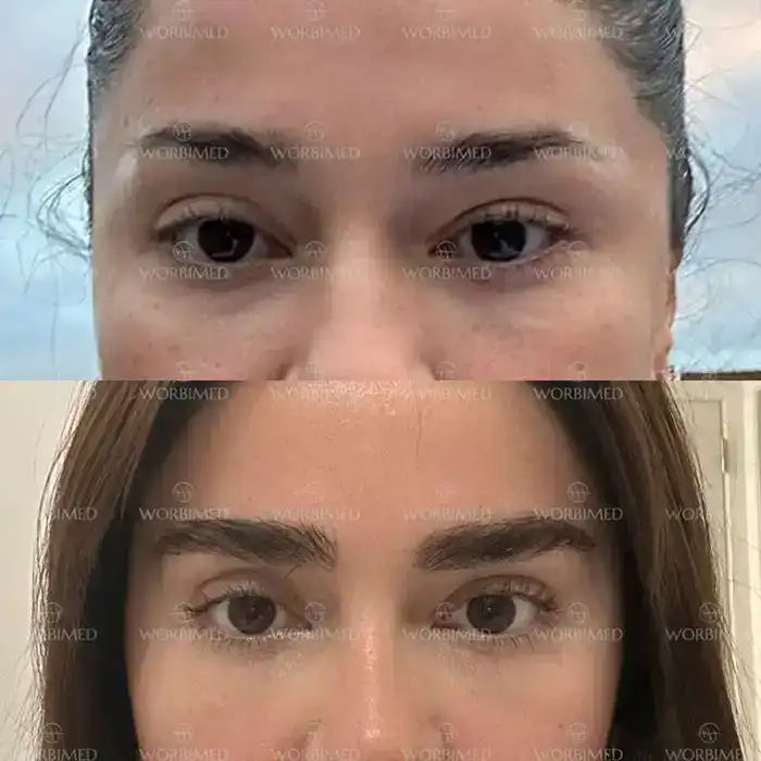 eyebrow transplant
