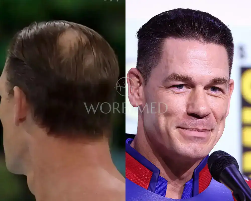 john cena hair transplant 2026