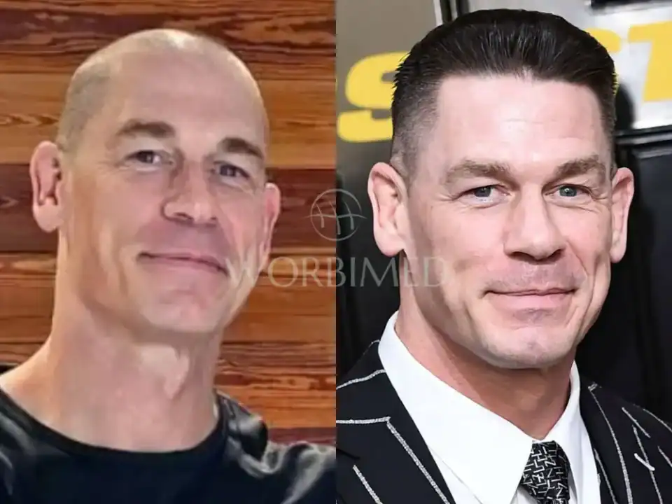 john cena hair transplant