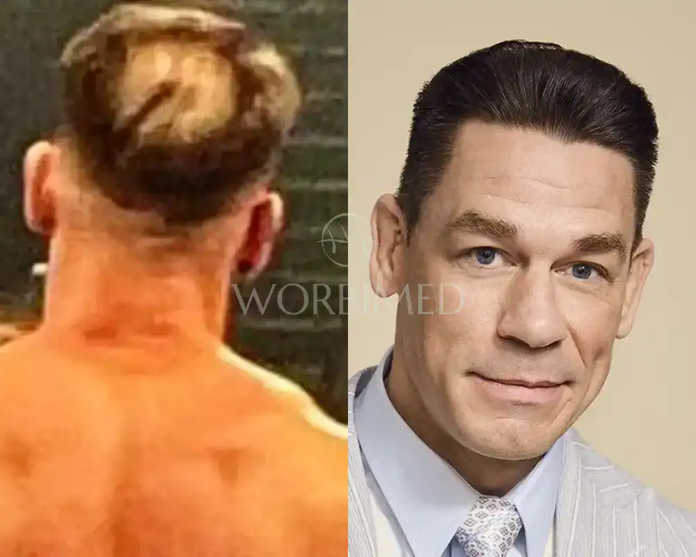 john cena hair transplant before and after