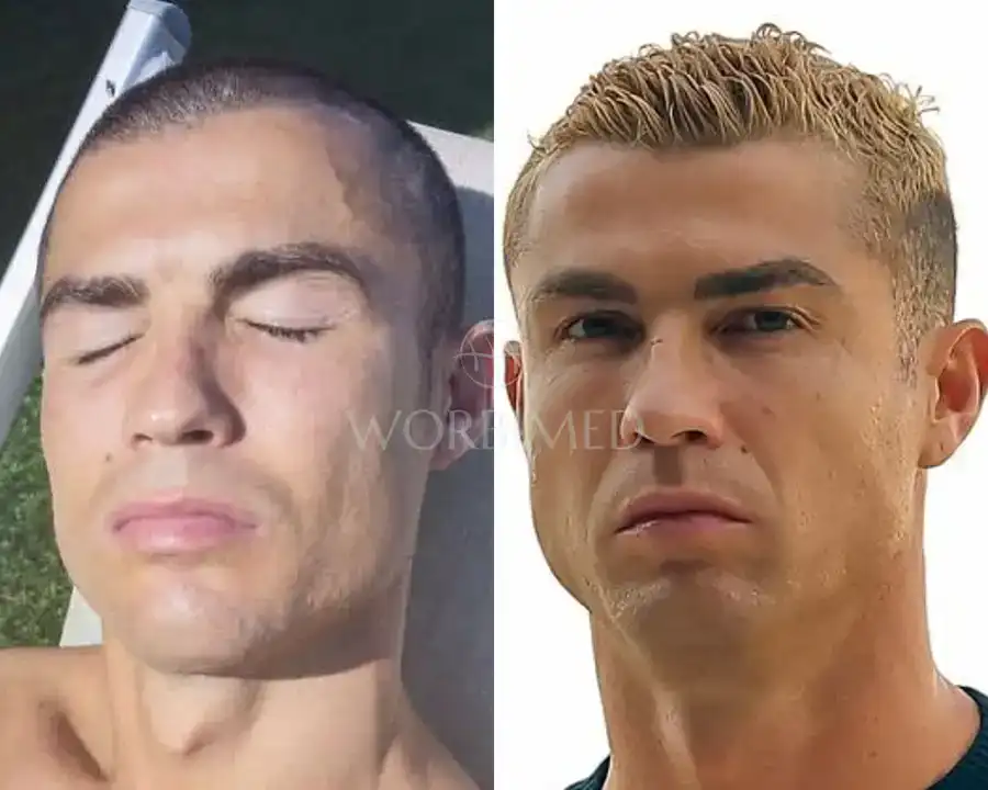 cristiano ronaldo hair transplant 2026