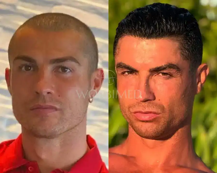 did cristiano ronaldo have a hair transplant