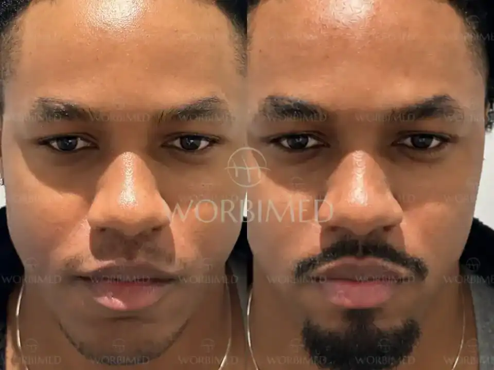 goatee beard transplant