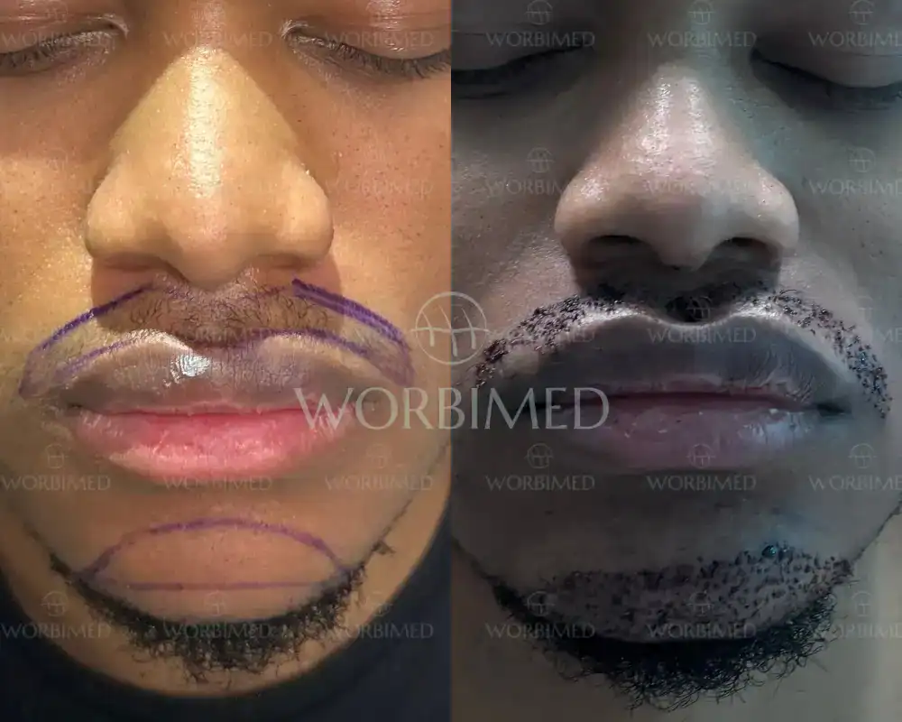goatee beard transplant before and after turkey