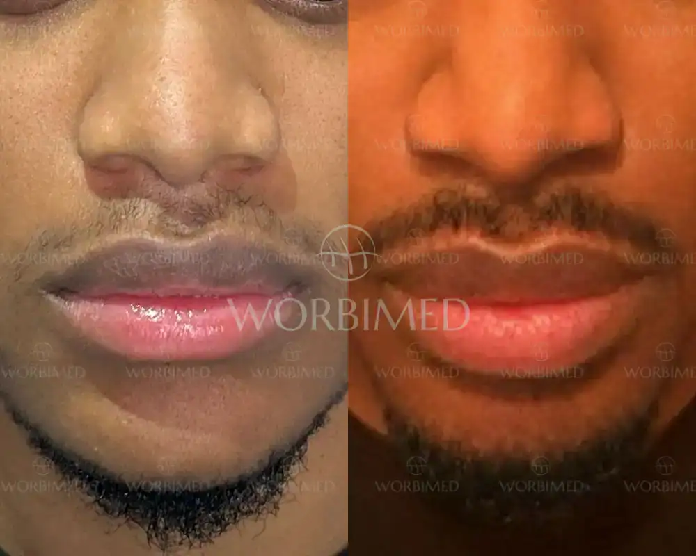 goatee beard transplant turkey